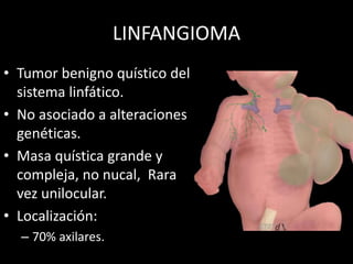 LINFANGIOMA
• Tumor benigno quístico del
sistema linfático.
• No asociado a alteraciones
genéticas.
• Masa quística grande y
compleja, no nucal, Rara
vez unilocular.
• Localización:
– 70% axilares.
 