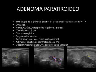 ADENOMA PARATIROIDEO
• TU benigno de la glándula paratiroidea que produce un exceso de PTH.Y
• Ovalados
• HIPOECOGÉNICOS respecto a la glándula tiroides.
• Tamaño: 0.8-1.5 cm
• Cápsula ecogénica.
• Degeneración quística.
• Calcificación rara. (ca – hiperparatiroidismo)
• Adenomas paratiroideos intratiroideos 2-5%
• Doppler: hipervasculares, vaso central y arco vascular.
 