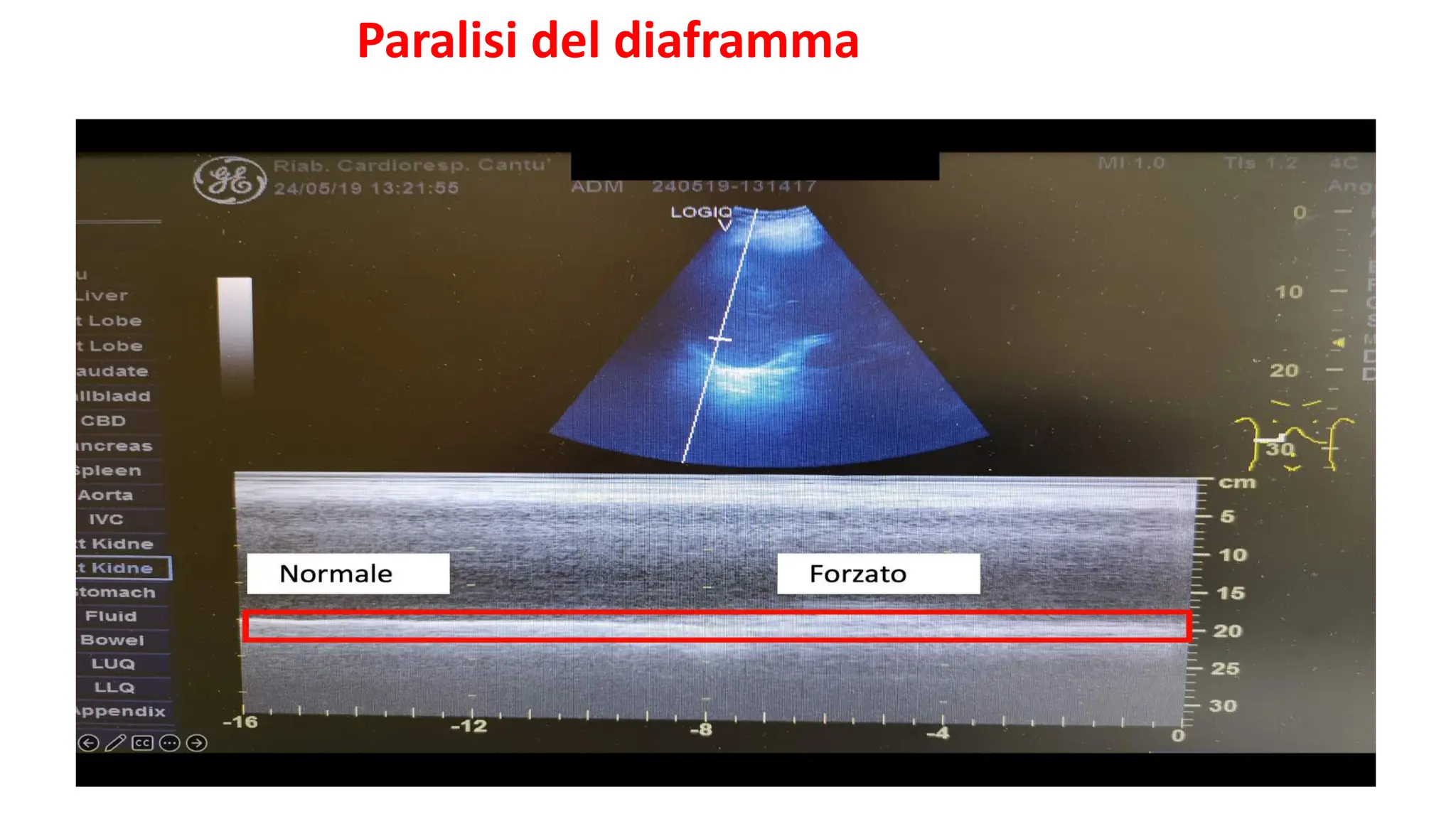 Dorman 994-038 Valvola di spurgo del contenitore di vapore compatibile con alcuni modelli Ford