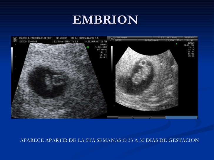 Ecografia Del Primer Trimestre
