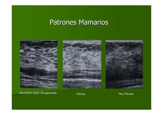 Patrones MamariosPatrones Mamarios
abundante tejido fibroglandularabundante tejido fibroglandular FibrosaFibrosa Muy FibrosaMuy Fibrosa
 