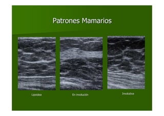Patrones MamariosPatrones Mamarios
En involuciEn involucióónnLipoideaLipoidea InvolutivaInvolutiva
 