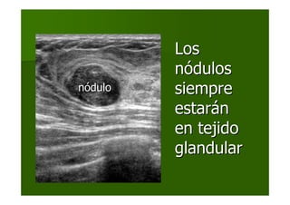 LosLos
nnóódulosdulos
siempresiempre
estarestaráánn
en tejidoen tejido
glandularglandular
nnóódulodulo
 