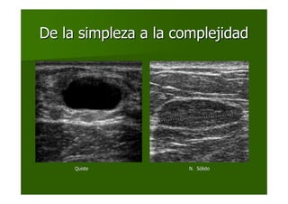 De la simpleza a la complejidadDe la simpleza a la complejidad
QuisteQuiste N. SN. Sóólidolido
 