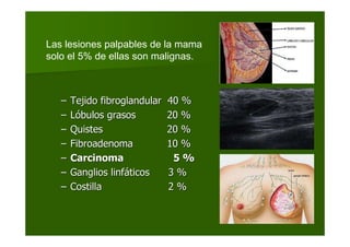 –– Tejido fibroglandular 40 %Tejido fibroglandular 40 %
–– LLóóbulos grasosbulos grasos 20 %20 %
–– QuistesQuistes 20 %20 %
–– FibroadenomaFibroadenoma 10 %10 %
–– CarcinomaCarcinoma 5 %5 %
–– Ganglios linfGanglios linfááticos 3 %ticos 3 %
–– CostillaCostilla 2 %2 %
Las lesiones palpables de la mama
solo el 5% de ellas son malignas.
 