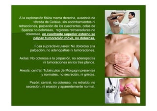 A la exploración física mama derecha, ausencia de
tétrada de Celsius, sin abombamientos ni
retracciones, palpación de los cuadrantes, colas de
Spence no dolorosas, regiones retroareolares no
dolorosas, en cuadrante superior externo se
palpan tumoración móvil, no dolorosa.
Fosa supraclaviculares: No dolorosa a la
palpación, no adenopatías ni tumoraciones.
Axilas: No dolorosa a la palpación, no adenopatías
ni tumoraciones en los tres planos.
Areola: central, Tubérculos de Morgagni presentes
y normales, no secreción, ni grietas.
Pezón: central, no doloroso, no retraído, no
secreción, ni erosión y aparentemente normal.
 