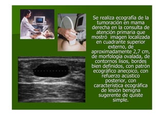 Se realiza ecografSe realiza ecografíía de laa de la
tumoracitumoracióón en maman en mama
derecha en la consulta dederecha en la consulta de
atenciatencióón primaria quen primaria que
mostrmostróó imagen localizadaimagen localizada
en cuadrante superioren cuadrante superior
externo, deexterno, de
aproximadamente 2,7 cm,aproximadamente 2,7 cm,
de morfologde morfologíía ovalada, dea ovalada, de
contornos lisos, bordescontornos lisos, bordes
bien definidos, con patrbien definidos, con patróónn
ecogrecográáfico anecoico, confico anecoico, con
refuerzo acrefuerzo acúústicostico
posterior, conposterior, con
caractercaracteríística ecogrstica ecográáficafica
de leside lesióón benignan benigna
sugerente de quistesugerente de quiste
simple.simple.
 