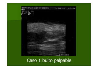 Caso 1 bulto palpable
 