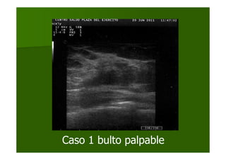 Caso 1 bulto palpable
 
