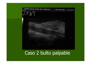 Caso 2 bulto palpable
 