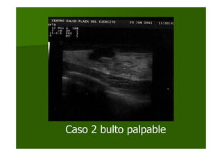 Caso 2 bulto palpable
 