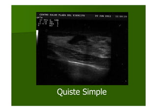Quiste Simple
 