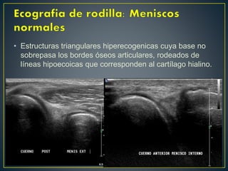 • Estructuras triangulares hiperecogenicas cuya base no
sobrepasa los bordes óseos articulares, rodeados de
líneas hipoecoicas que corresponden al cartílago hialino.
 