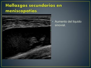 • Aumento del liquido
sinovial.
 