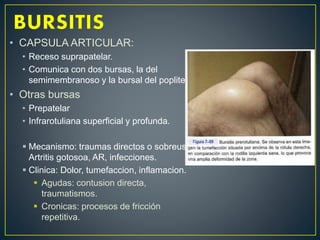 • CAPSULA ARTICULAR:
• Receso suprapatelar.
• Comunica con dos bursas, la del
semimembranoso y la bursal del popliteo
• Otras bursas
• Prepatelar
• Infrarotuliana superficial y profunda.
 Mecanismo: traumas directos o sobreuso.
Artritis gotosoa, AR, infecciones.
 Clinica: Dolor, tumefaccion, inflamacion.
 Agudas: contusion directa,
traumatismos.
 Cronicas: procesos de fricción
repetitiva.
 