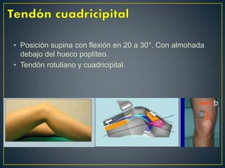 • Posición supina con flexión en 20 a 30°. Con almohada
debajo del hueco poplíteo.
• Tendón rotuliano y cuadricipital.
 