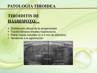 Ecografia de tiroides