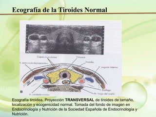 Ecografia de tiroides