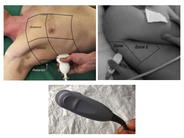 Resultado de imagen para transductor de torax