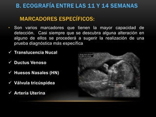 • Son varios marcadores que tienen la mayor capacidad de
detección. Casi siempre que se descubra alguna alteración en
alguno de ellos se procederá a sugerir la realización de una
prueba diagnóstica más específica
 Translucencia Nucal
 Ductus Venoso
 Huesos Nasales (HN)
 Válvula tricúspidea
 Arteria Uterina
MARCADORES ESPECÍFICOS:
 