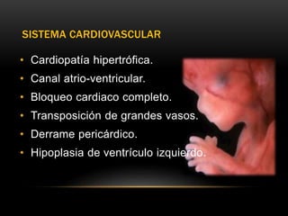 SISTEMA CARDIOVASCULAR
• Cardiopatía hipertrófica.
• Canal atrio-ventricular.
• Bloqueo cardiaco completo.
• Transposición de grandes vasos.
• Derrame pericárdico.
• Hipoplasia de ventrículo izquierdo.
 