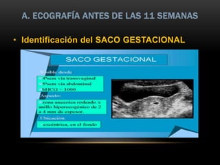A. ECOGRAFÍA ANTES DE LAS 11 SEMANAS
• Identificación del SACO GESTACIONAL
 