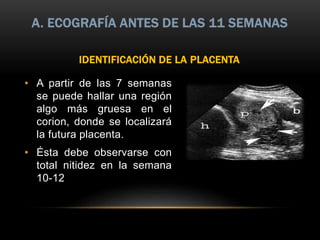 IDENTIFICACIÓN DE LA PLACENTA
• A partir de las 7 semanas
se puede hallar una región
algo más gruesa en el
corion, donde se localizará
la futura placenta.
• Ésta debe observarse con
total nitidez en la semana
10-12
A. ECOGRAFÍA ANTES DE LAS 11 SEMANAS
 