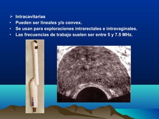  Intracavitarias
• Pueden ser lineales y/o convex.
• Se usan para exploraciones intrarectales e intravaginales.
• Las frecuencias de trabajo suelen ser entre 5 y 7.5 MHz.
 