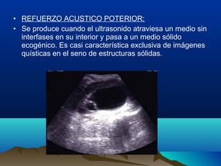 • REFUERZO ACUSTICO POTERIOR:
• Se produce cuando el ultrasonido atraviesa un medio sin
interfases en su interior y pasa a un medio sólido
ecogénico. Es casi característica exclusiva de imágenes
quísticas en el seno de estructuras sólidas.
 