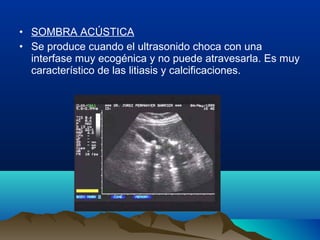 • SOMBRA ACÚSTICA
• Se produce cuando el ultrasonido choca con una
interfase muy ecogénica y no puede atravesarla. Es muy
característico de las litiasis y calcificaciones.
 