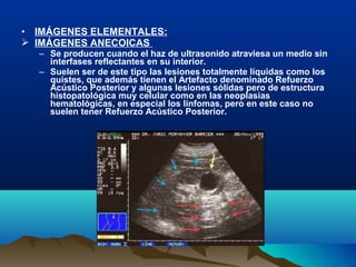 • IMÁGENES ELEMENTALES:
 IMÁGENES ANECOICAS
– Se producen cuando el haz de ultrasonido atraviesa un medio sin
interfases reflectantes en su interior.
– Suelen ser de este tipo las lesiones totalmente líquidas como los
quistes, que además tienen el Artefacto denominado Refuerzo
Acústico Posterior y algunas lesiones sólidas pero de estructura
histopatológica muy celular como en las neoplasias
hematológicas, en especial los linfomas, pero en este caso no
suelen tener Refuerzo Acústico Posterior.
 