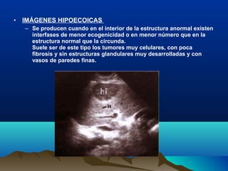 • IMÁGENES HIPOECOICAS
– Se producen cuando en el interior de la estructura anormal existen
interfases de menor ecogenicidad o en menor número que en la
estructura normal que la circunda.
Suele ser de este tipo los tumores muy celulares, con poca
fibrosis y sin estructuras glandulares muy desarrolladas y con
vasos de paredes finas.
 