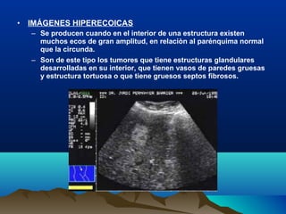 • IMÁGENES HIPERECOICAS
– Se producen cuando en el interior de una estructura existen
muchos ecos de gran amplitud, en relaciòn al parénquima normal
que la circunda.
– Son de este tipo los tumores que tiene estructuras glandulares
desarrolladas en su interior, que tienen vasos de paredes gruesas
y estructura tortuosa o que tiene gruesos septos fibrosos.
 