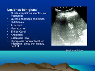 Angioma tìpicoAngioma tìpico
Lesiones benignas:
• Quistes hepàticos simples ,son
frecuentes
• Quistes hepàticos complejos
• Hidatidosis
• Abscesos
• Hematomas
• Enf.de Caroli
• Angiomas
• Esteatosis focal
• Hiperplasia nodular focal ,es
frecuente , ùnica con cicatriz
central
 