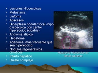 Hepatoma Hipoecoico enHepatoma Hipoecoico en
lòbulo caudadolòbulo caudado
• Lesiones Hipoecoicas
• Metàstasis
• Linfoma
• Abscesos
• Hiperplasia nodular focal -hipo
o isoecoica con centro
hiperecoico (cicatriz)
• Angioma atipico
• Hepatoma
• Adenoma ,màs frecuente que
sea hiperecoico.
• Nòdulos regenerativos
cirròticos
• Infarto hepàtico
• Quiste complejo
 