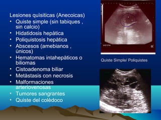 Quiste Simple/ PoliquistesQuiste Simple/ Poliquistes
Lesiones quìsiticas (Anecoicas)
• Quiste simple (sin tabiques ,
sin calcio)
• Hidatidosis hepàtica
• Poliquistosis hepàtica
• Abscesos (amebianos ,
ùnicos)
• Hematomas intahepàticos o
biliomas
• Cistoadenoma biliar
• Metàstasis con necrosis
• Malformaciones
arteriovenosas
• Tumores sangrantes
• Quiste del colèdoco
 