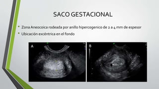 SACO GESTACIONAL
• ZonaAneocoica rodeada por anillo hipercogenico de 2 a 4 mm de espesor
• Ubicación excéntrica en el fondo
 
