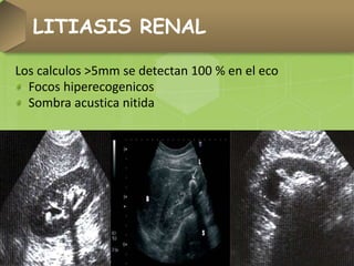 Los calculos >5mm se detectan 100 % en el eco
Focos hiperecogenicos
Sombra acustica nitida
LITIASIS RENAL
 