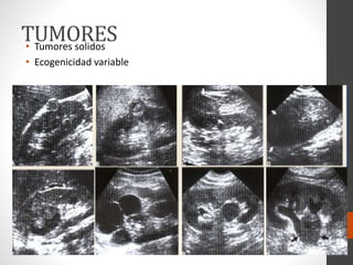 TUMORES• Tumores solidos
• Ecogenicidad variable
 