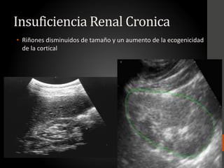 Insuficiencia Renal Cronica
• Riñones disminuidos de tamaño y un aumento de la ecogenicidad
de la cortical
 