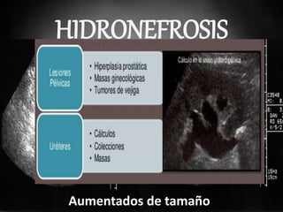 HIDRONEFROSIS
Aumentados de tamaño
 