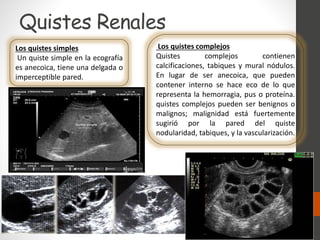 Quistes Renales
Los quistes simples
Un quiste simple en la ecografía
es anecoica, tiene una delgada o
imperceptible pared.
Los quistes complejos
Quistes complejos contienen
calcificaciones, tabiques y mural nódulos.
En lugar de ser anecoica, que pueden
contener interno se hace eco de lo que
representa la hemorragia, pus o proteína.
quistes complejos pueden ser benignos o
malignos; malignidad está fuertemente
sugirió por la pared del quiste
nodularidad, tabiques, y la vascularización.
 
