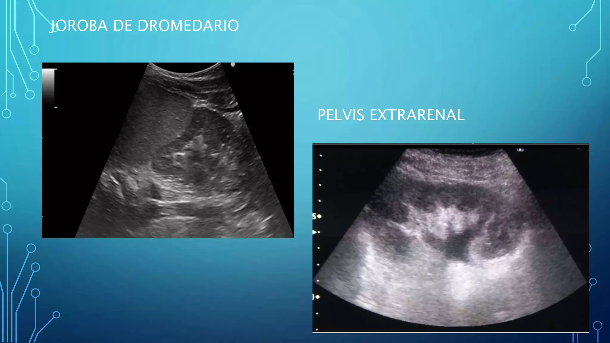 ECOGRAFIA RENAL.pptx