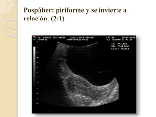 Pospúber: piriforme y se invierte a 
relación. (2:1) 
 