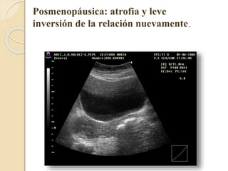 Posmenopáusica: atrofia y leve 
inversión de la relación nuevamente. 
 
