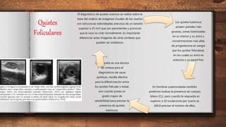 Quistes
Foliculares
Los quistes luteínicos
poseen paredes más
gruesas, zonas luteinizadas
en su interior y su antro y
concentraciones más altas
de progesterona en sangre
que los quistes foliculares,
en los cuales su antro es
anecoico y su pared fina.
En hembras superovuladas también
podemos evaluar la presencia de cuerpos
lúteos (CL), pero cuando la respuesta es
superior a 10 ovulaciones por ovario es
difícil precisar el número de ellos.
La ecografía es una técnica
de certeza para el
diagnósticos de vacas
quísticas, resulta efectiva
para la diferenciación entre
los quistes folicular y luteal,
aún cuando posee un
grado mayor de
sensibilidad para precisar la
presencia de quistes
luteínicos.
El diagnóstico de quistes ováricos se realiza sobre la
base del análisis de imágenes visuales de los ovarios
con estructuras redondeadas anecoica de un tamaño
superior a 25 mm que son persistentes y provocan
que la vaca no cicle normalmente. Es importante
diferenciar estas imágenes de otras similares que
pueden ser artefactos.
 