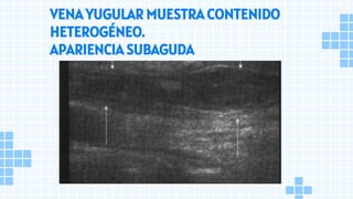 VENA YUGULAR MUESTRA CONTENIDO
HETEROGÉNEO.
APARIENCIA SUBAGUDA
 