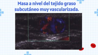 Masa a nivel del tejido graso
subcutáneo muy vascularizada.
 