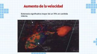 Aumento de la velocidad
Estenosis significativa mayor de un 70% en carótida
interna.
 