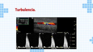 Turbulencia.
 
